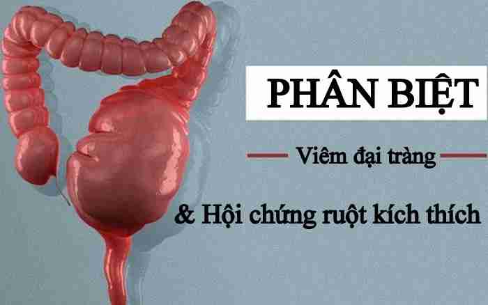 Viêm đại tràng khác với đại tràng co thắt (hội chứng ruột kích thích)