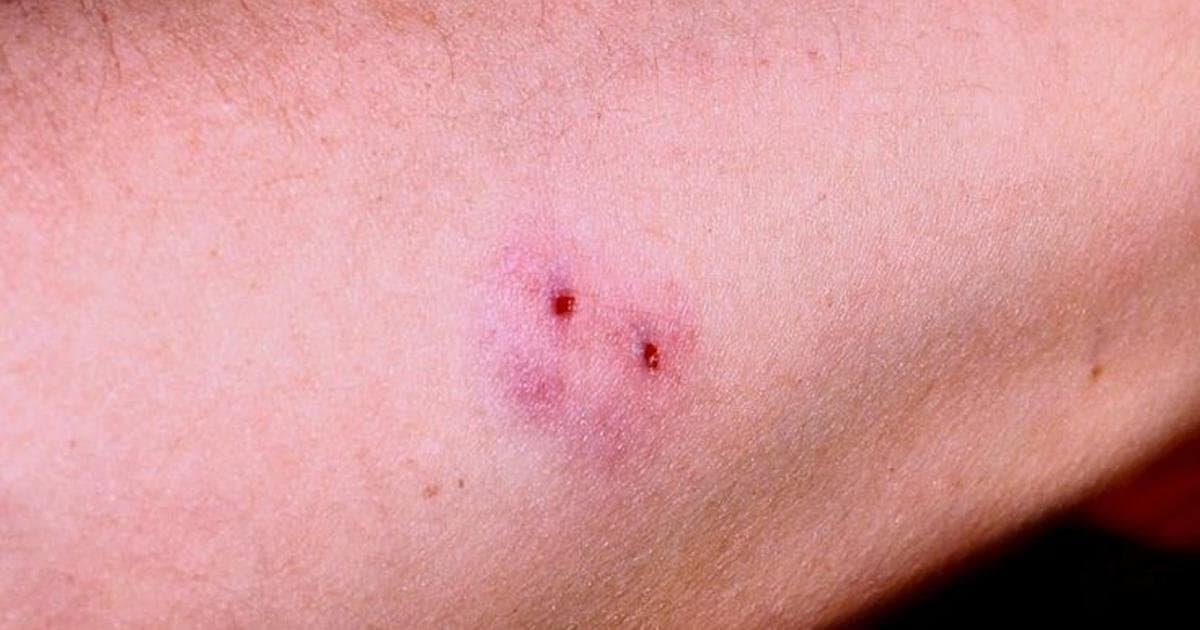 Dấu răng của rắn độc