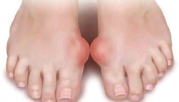 Cách chữa bệnh gút tại nhà và những thực phẩm bệnh gút cần kiêng kị