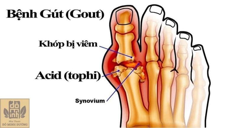 Bệnh Gút