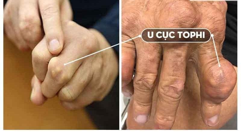 Cục tophi (bệnh gút)