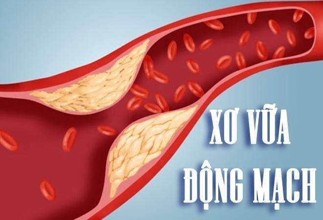 Xơ vữa động mạch