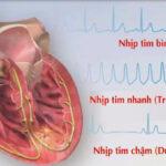 Rối loạn nhịp tim